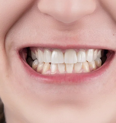 After cosmetic treatment
